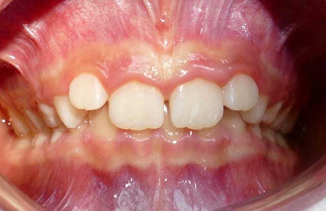 Deep bite - Does my child need braces?